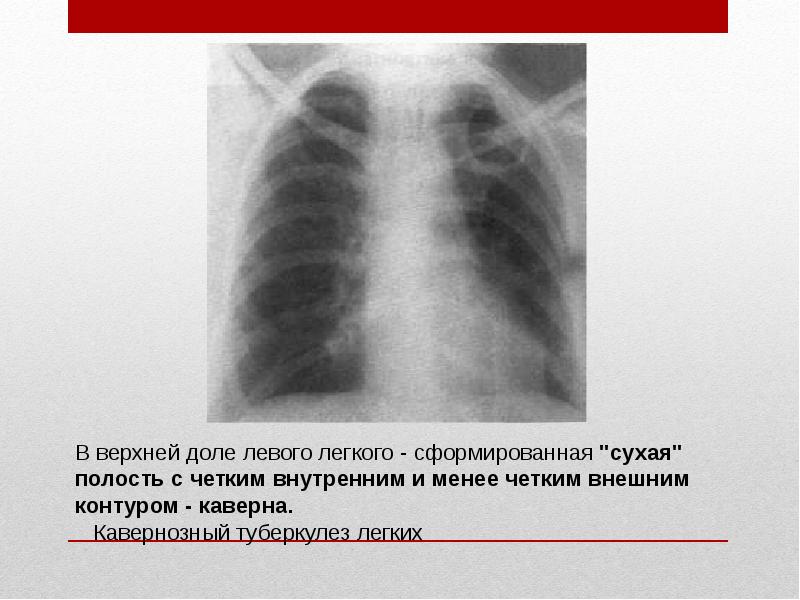 10 поражение легких