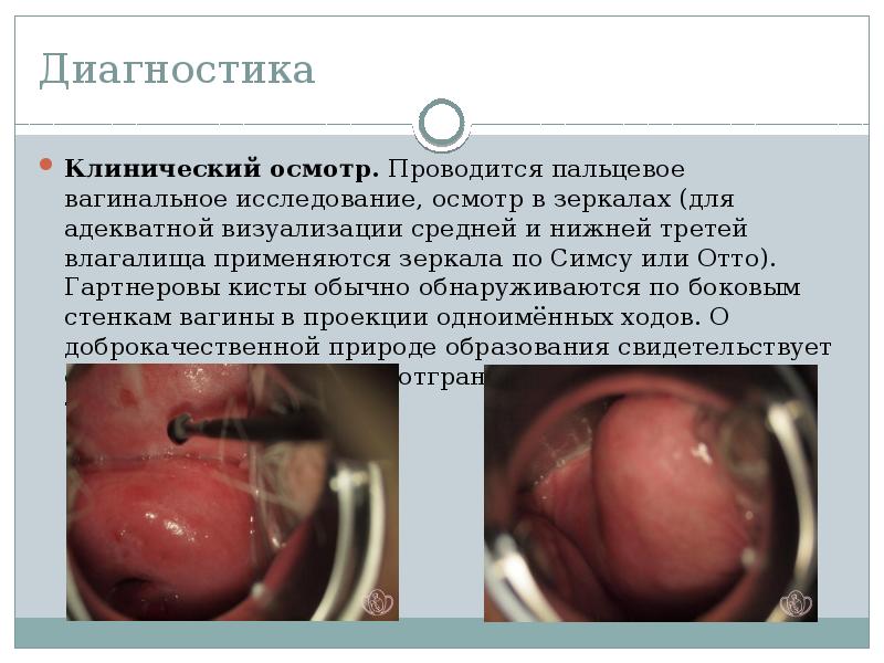 Удаление кисты влагалища в Москве, цена операции в клинике АльтраВита