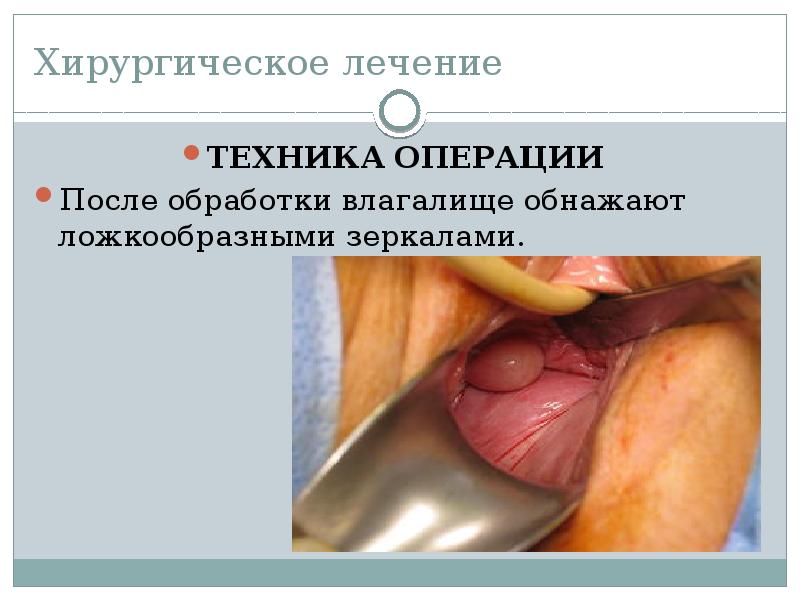 Хирургическое лечение
ТЕХНИКА ОПЕРАЦИИ
После обработки влагалище обнажают ложкообразными зеркалами. Хирургическое лечение
ТЕХНИКА ОПЕРАЦИИ
После обработки влагалище обнажают ложкообразными зеркалами.