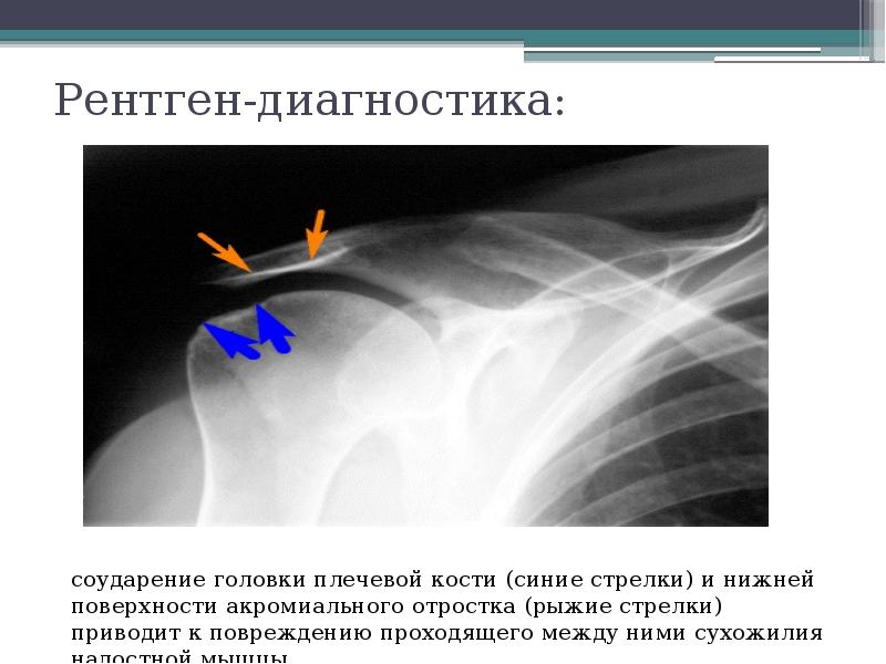 Рассмотрите рентгенограмму с изображением плечевого сустава человека как называют повреждение