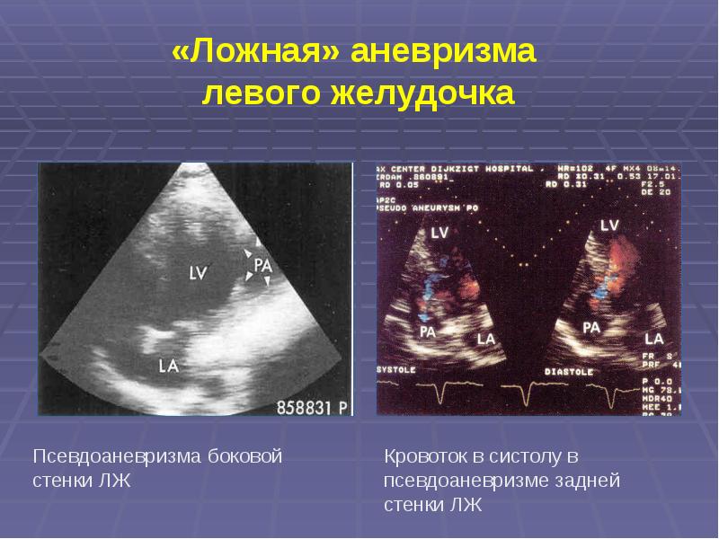 Стенки повышенной эхогенности