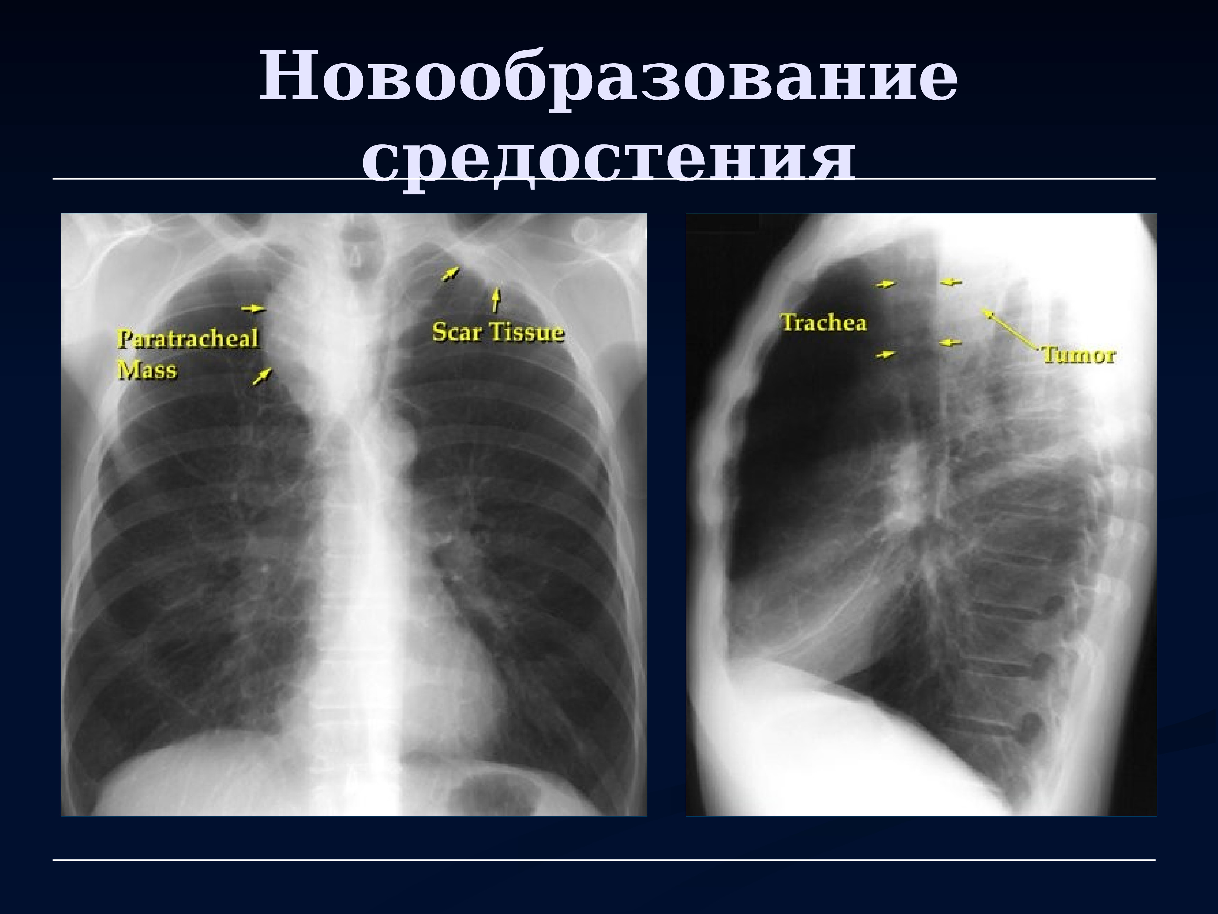 Лучевая диагностика средостения презентация