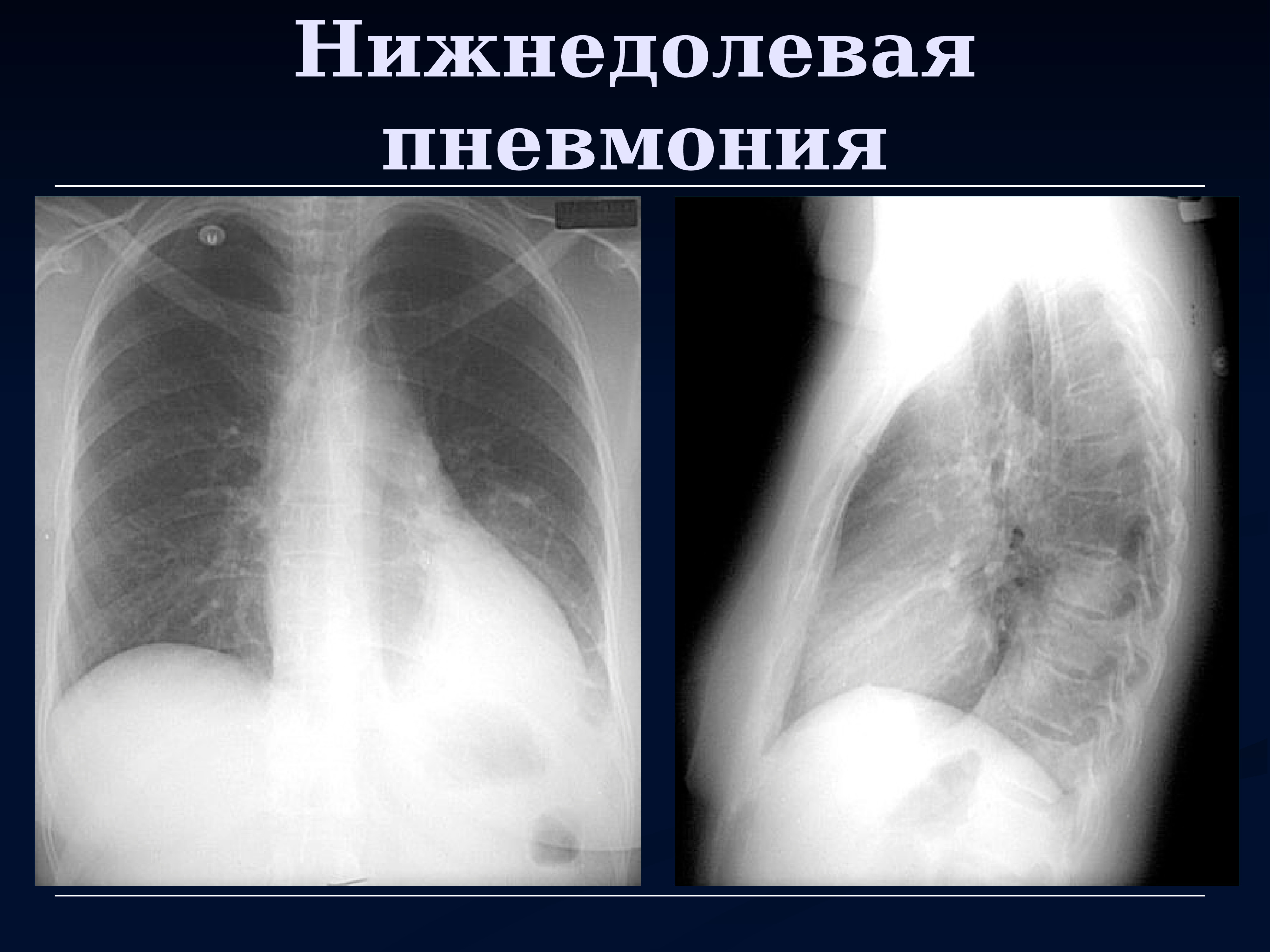 Пневмония в правом легком в нижней доле. Левосторонняя нижнедолевая пневмония рентген. Крупозная нижнедолевая пневмония рентгенограмма. Рентген левосторонняя крупозная пневмония. Пневмония нижней доли рентген.