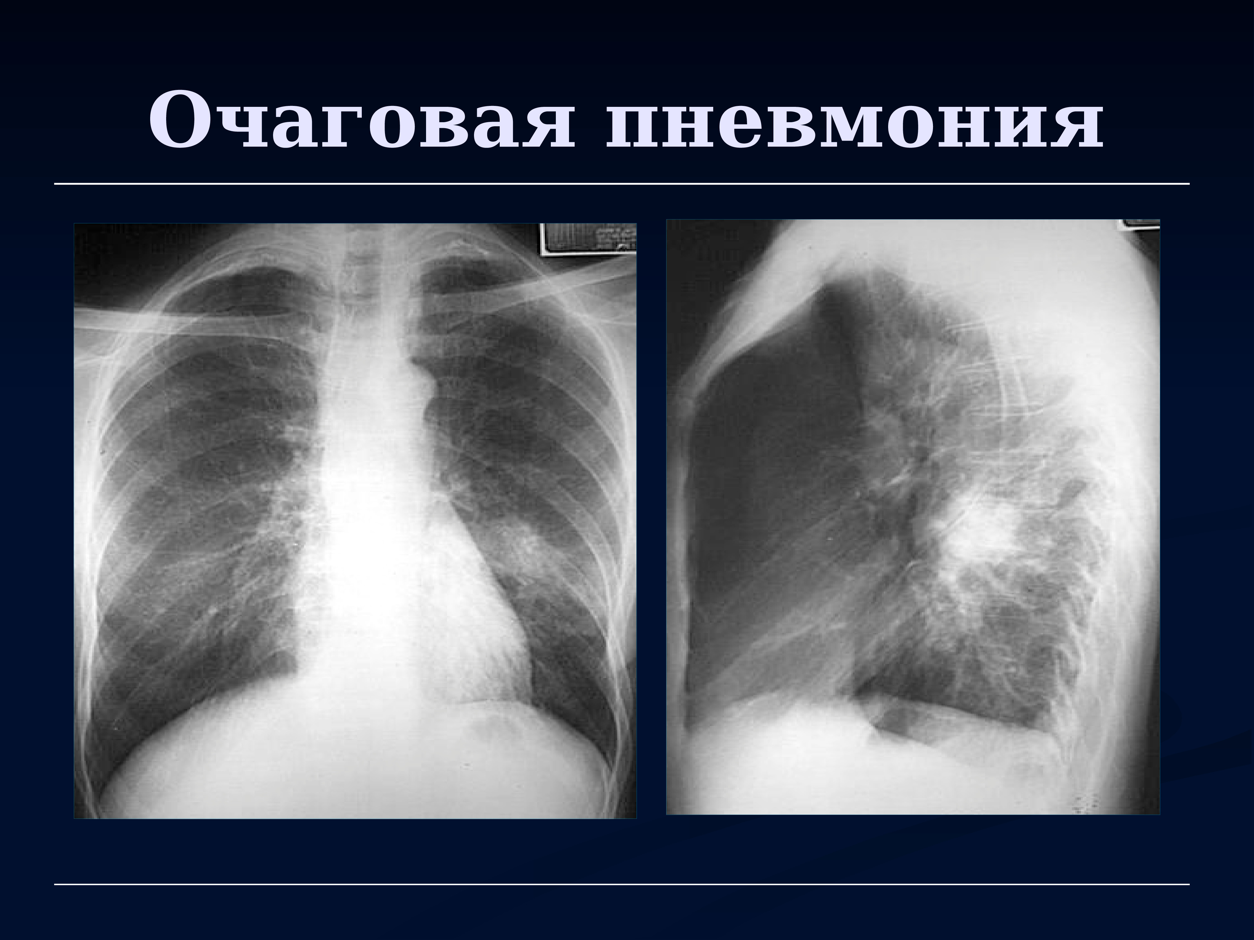 Очагово сливная пневмония рентген