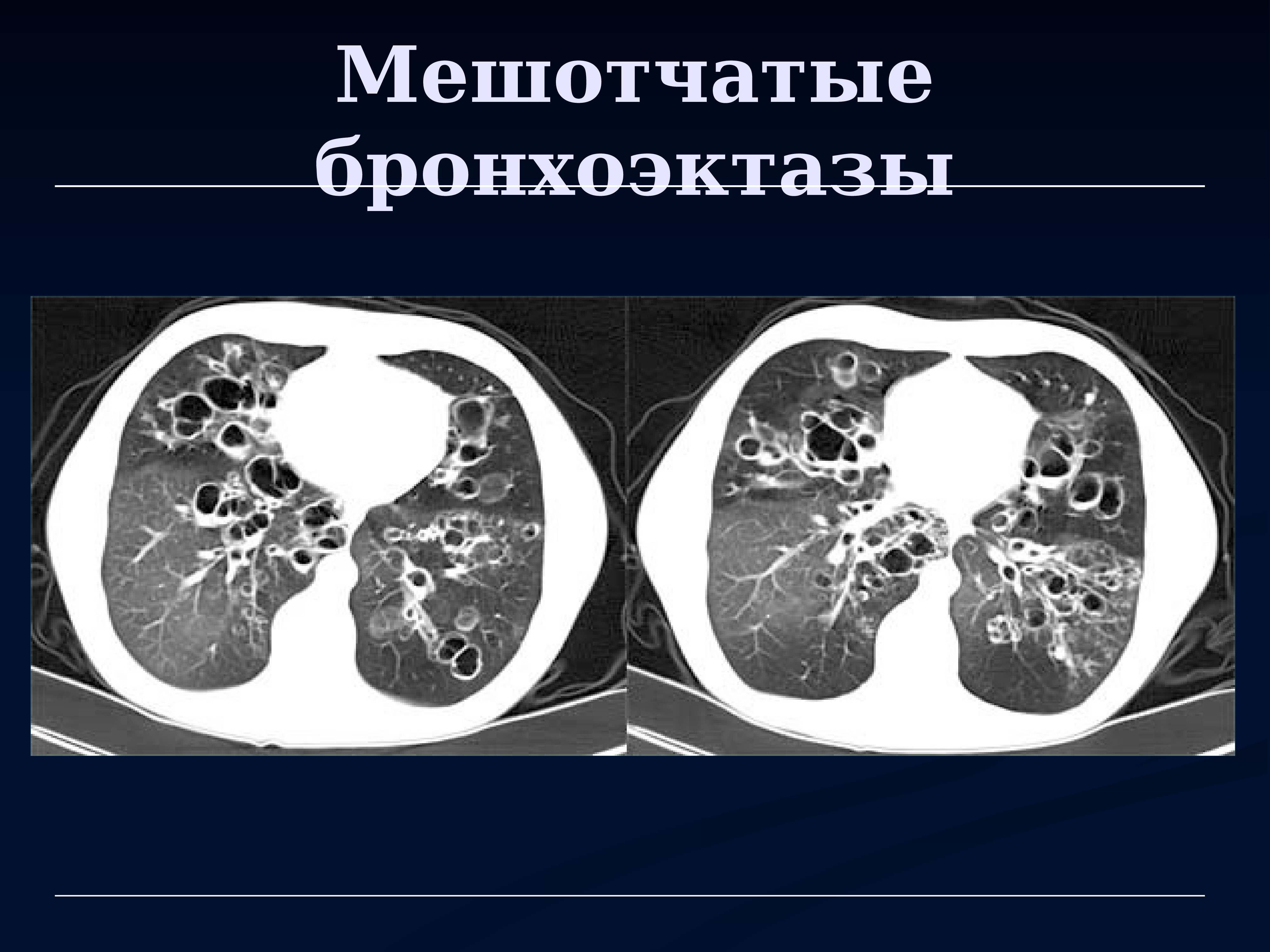 Приобретенные бронхоэктазы