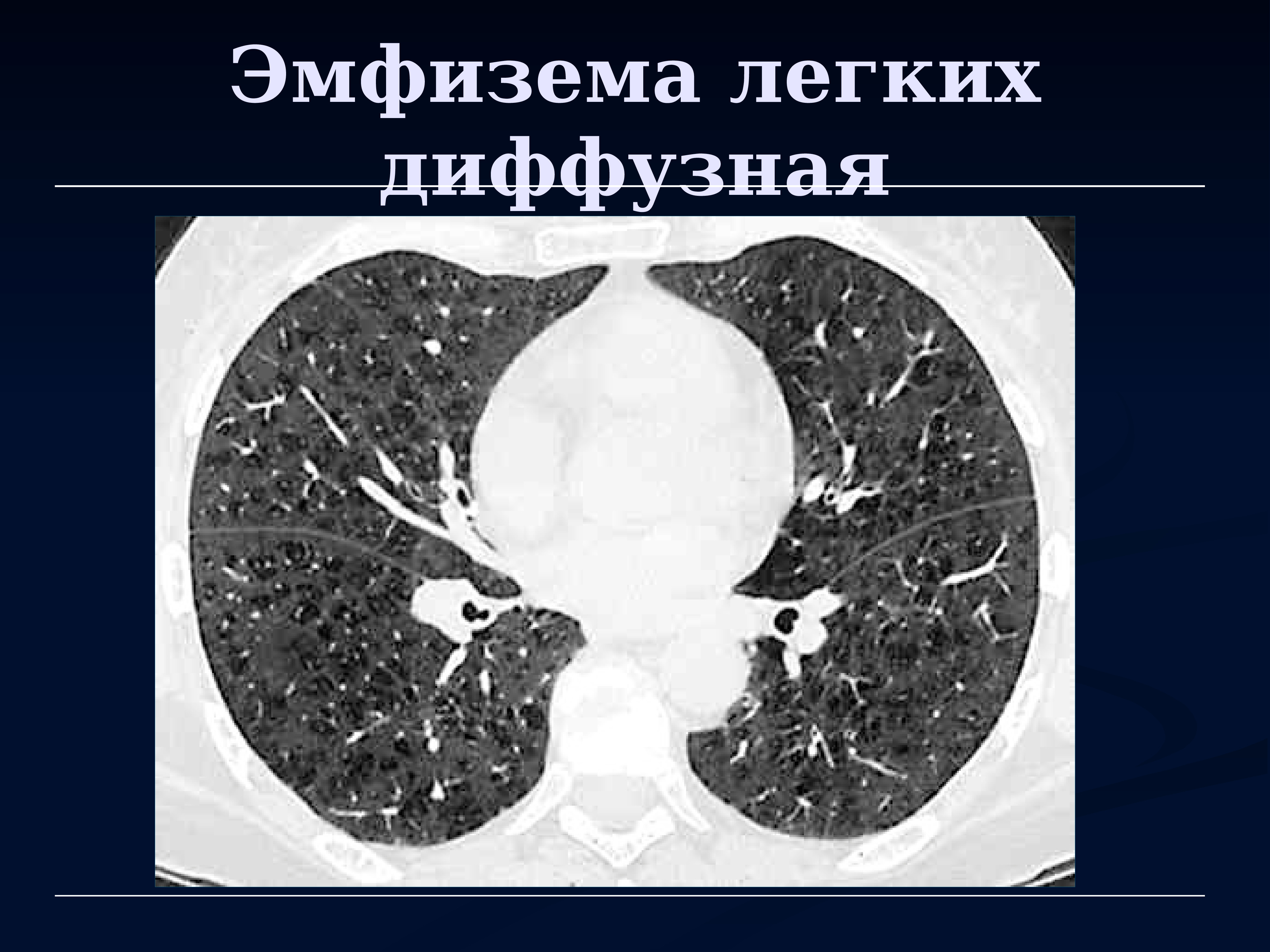 Диффузный пневмосклероз это рак. Центрилобулярная эмфизема на кт. Парасептальная эмфизема легких на кт. Диффузная эмфизема легких на кт.
