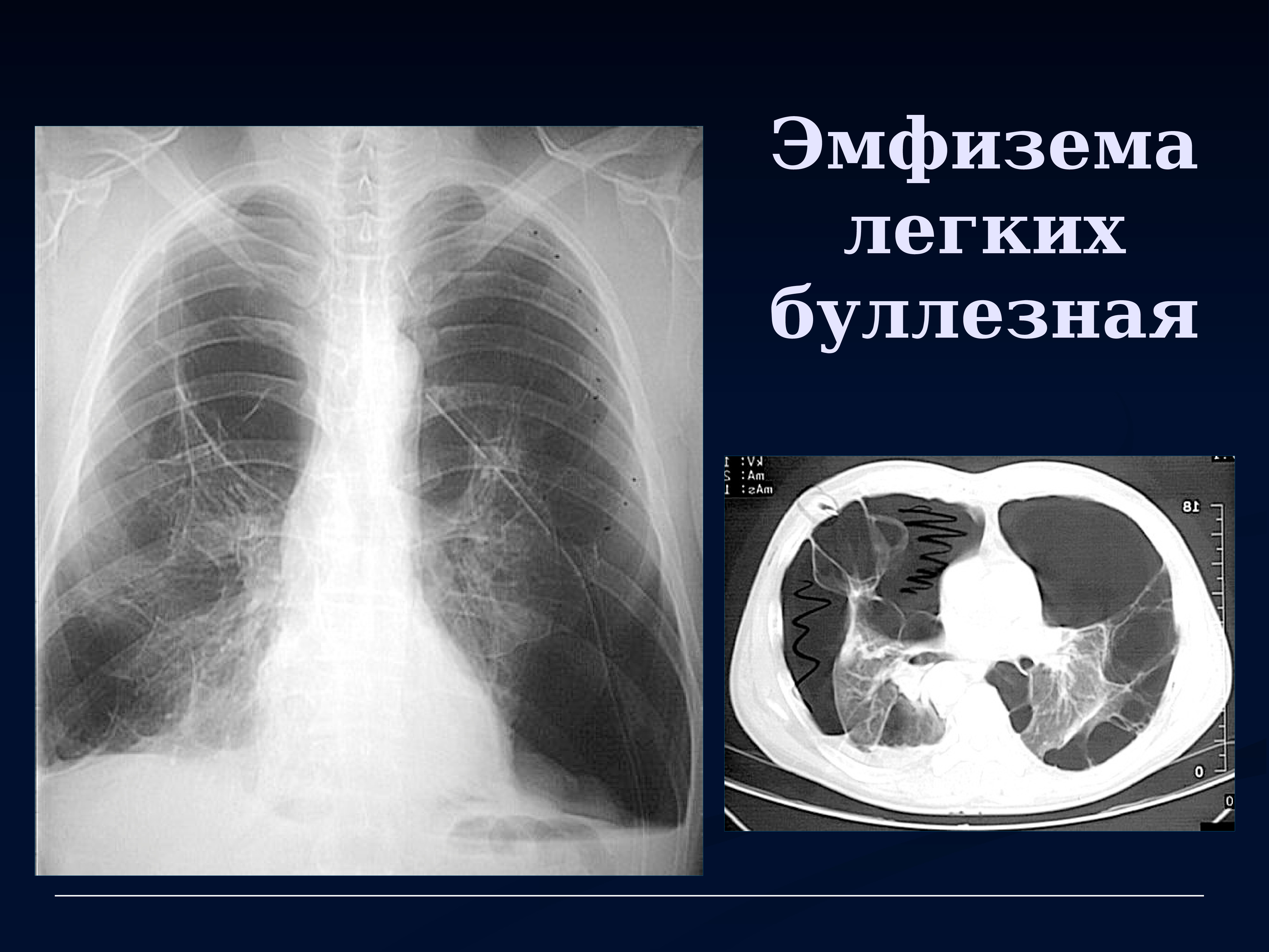 Бул легкие. Эмфизема легких рентгенограмма. Рентгенодиагностика эмфиземы легких. Легочная эмфизема рентген. Буллезная эмфизема на рентгенограмме.