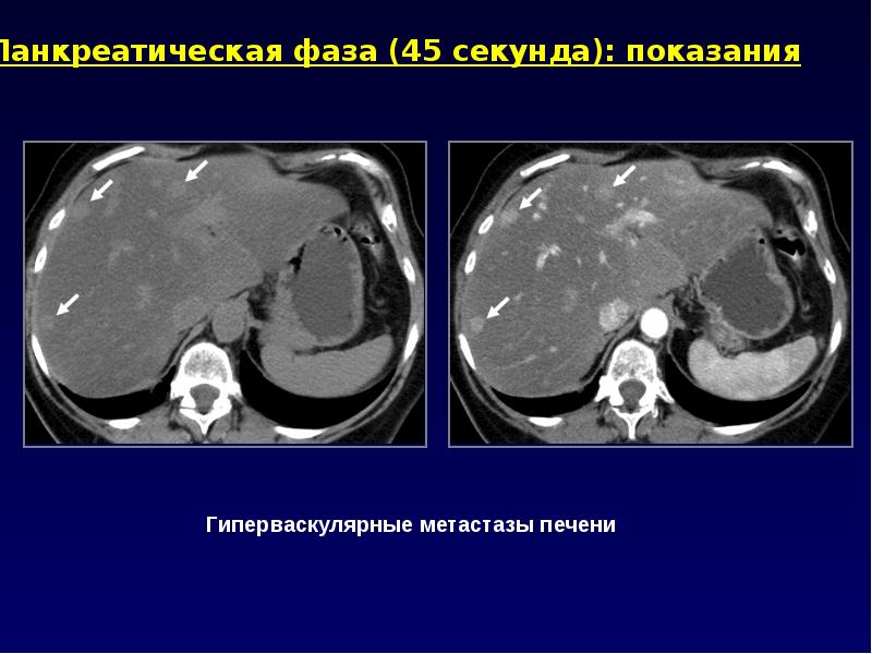Как выглядят метастазы в печени на кт с контрастом фото