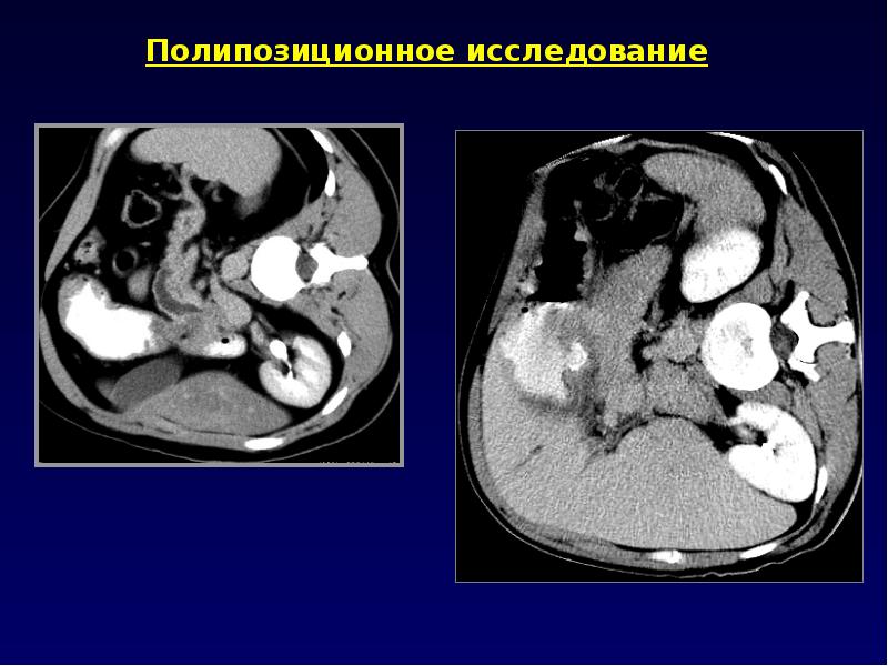 Компьютерная томография презентация