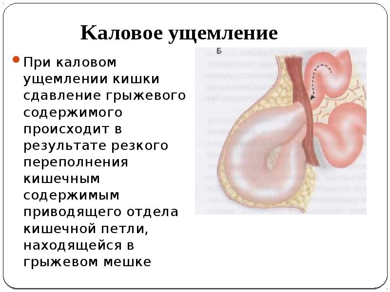 Ущемленная грыжа презентация