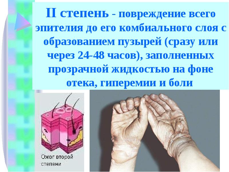 Презентация ожоги биология 8 класс