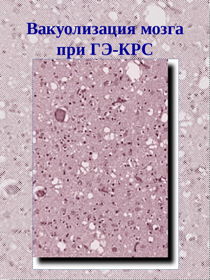 Губчатая энцефалопатия крс. Губчатая энцефалопатия крупного. Губкообразная энцефалопатия гистология. Губкообразная энцефалопатия крс. Губчатая энцефалопатия крупного.