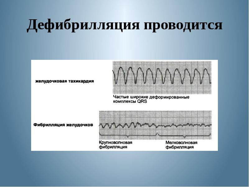 Дефибрилляция при асистолии. Дефибрилляция. экг при дефибрилляции. дефибрилляция сердца.