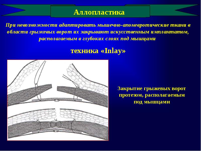 Аллопластическая картина болезни это