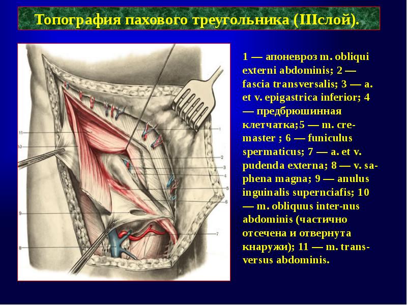 Схема топографии пахового канала