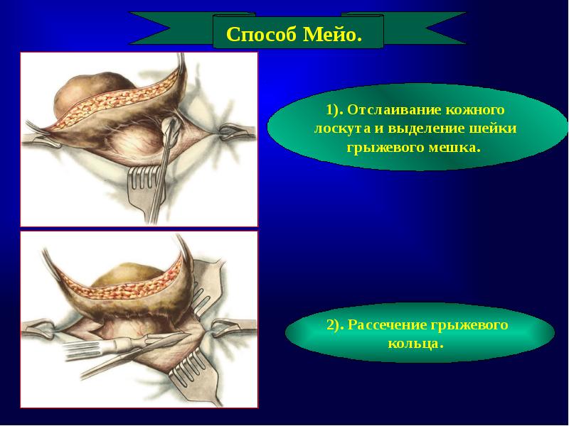 Пластика по мейо картинки