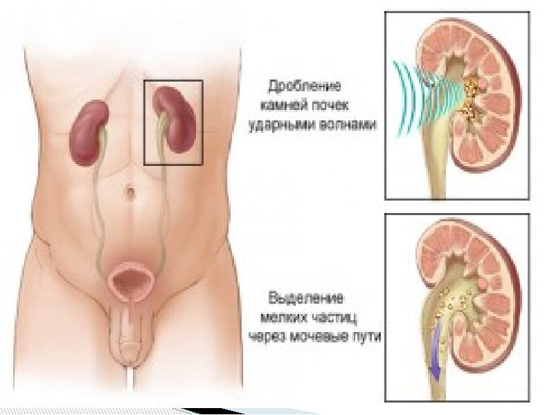 Почки у мужчин. Камни в почках симптомы у женщин. Камень в мочеточнике у мужчин.