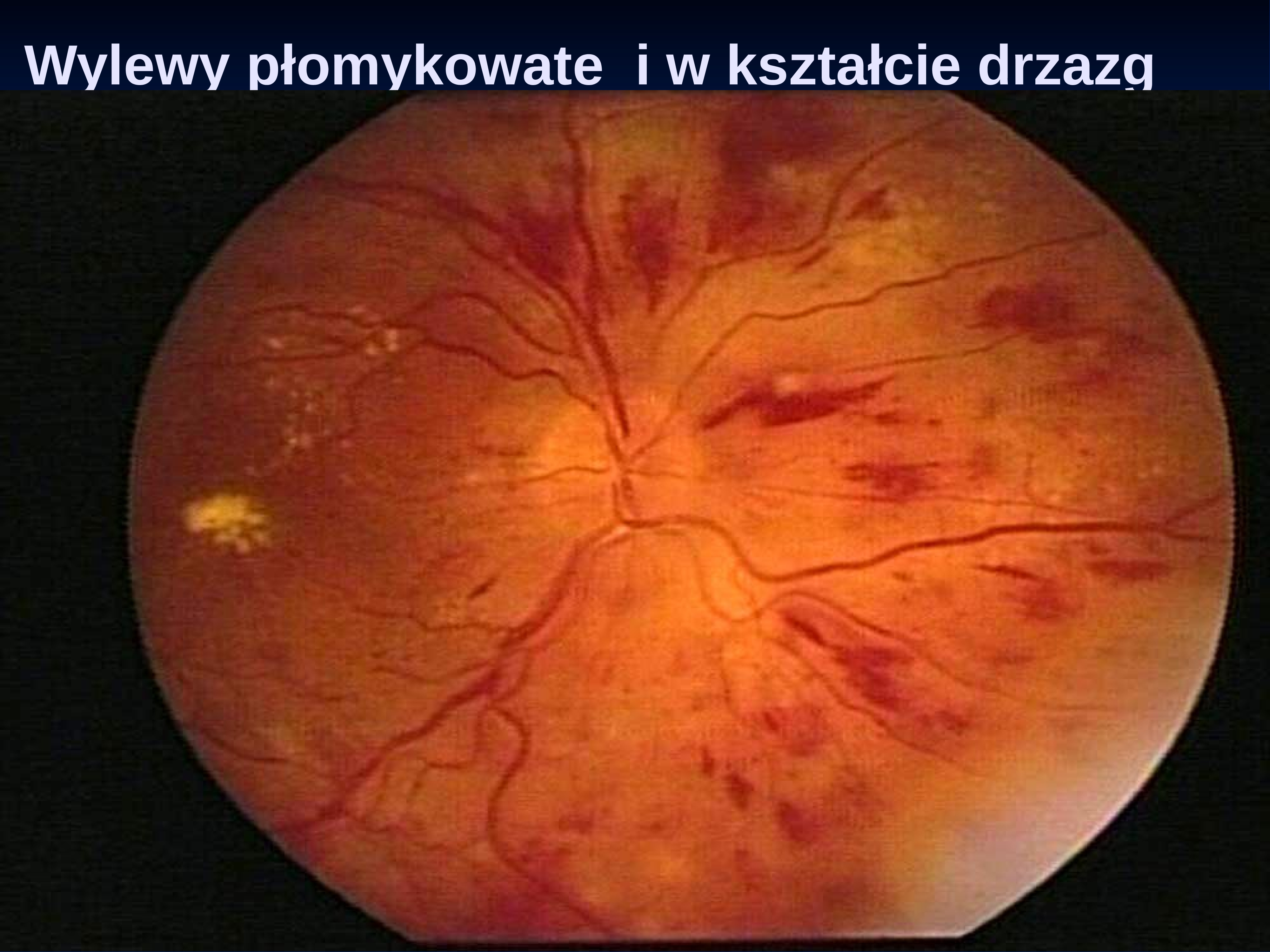 Глазное дно гипертоническая ретинопатия