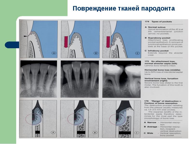 Комплексное лечение заболеваний пародонта презентация