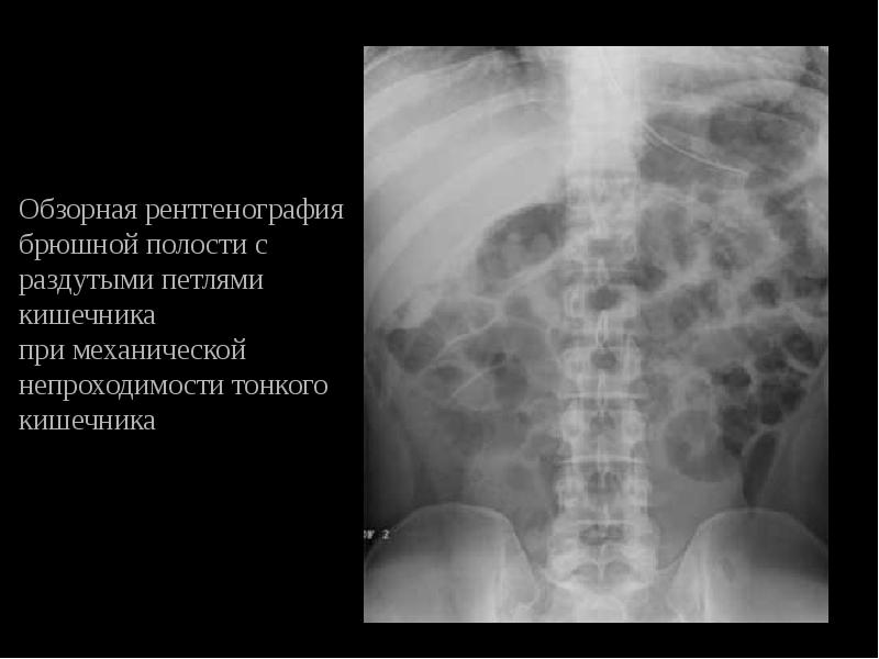 Рентген брюшной полости фото норма