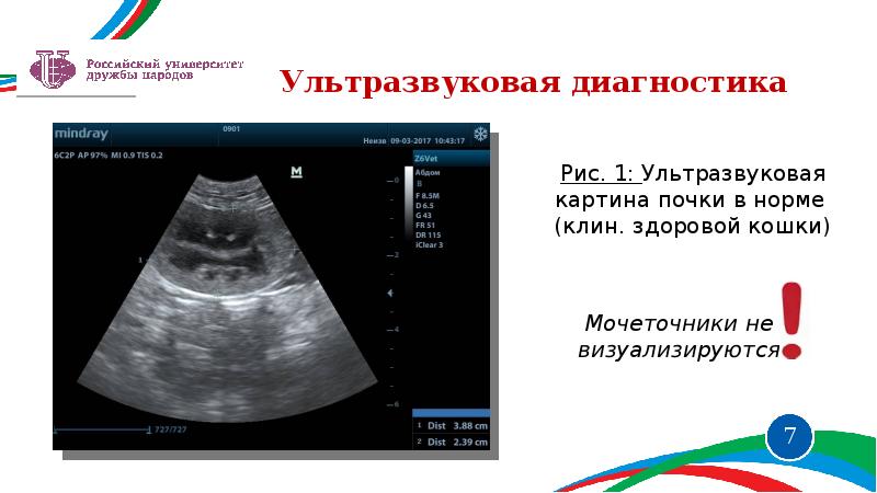 Мкб 83.8. Гидронефротическая трансформация почки на УЗИ. Гидронефроз мкб. Стадии гидронефроза на УЗИ.