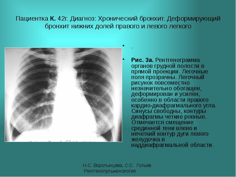 Усиление бронхиального рисунка