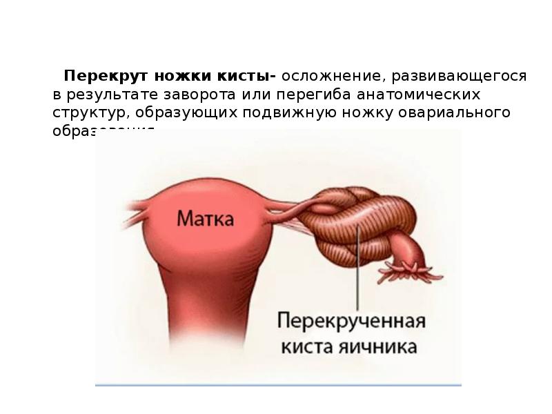 Перекрут придатков матки презентация