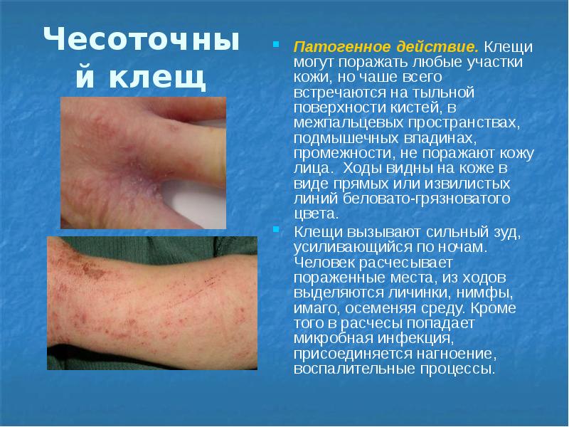 Чесоточный клещ