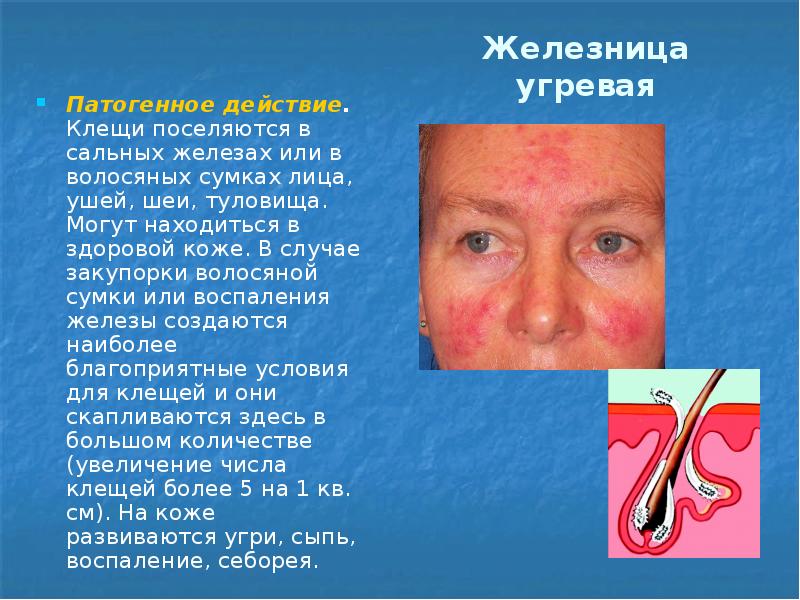 Железница угревая Патогенное действие. Клещи поселяются в сальных железах или в