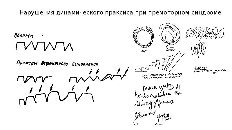 Кинетический праксис. Нарушение динамического праксиса. Проба на динамический Праксис. Обследование динамического праксиса. Нарушение кинетического праксиса.