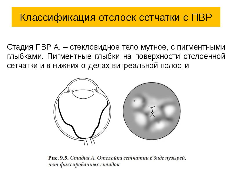 Как создается четкое изображение на сетчатке когда