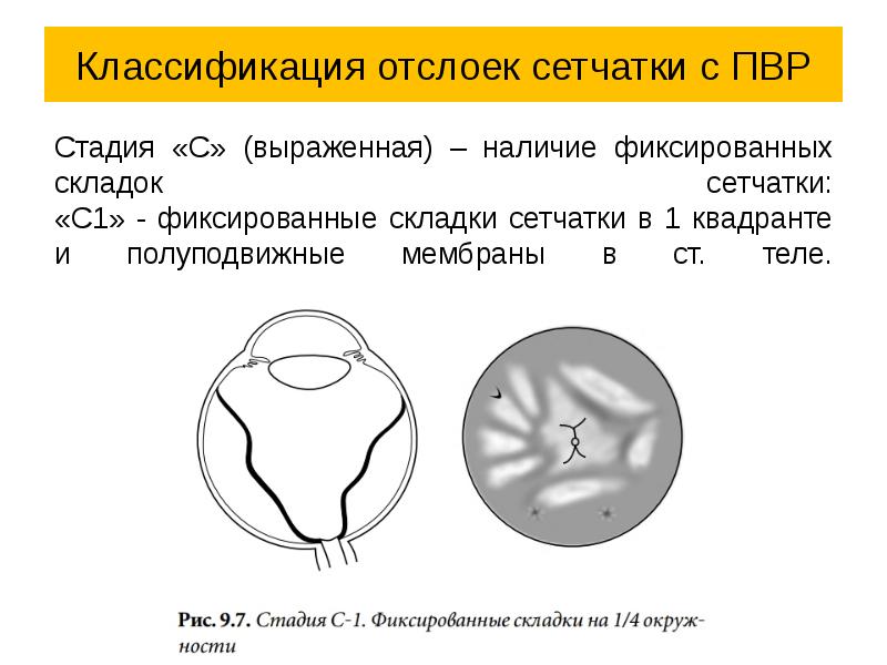 Презентация отслоение сетчатки