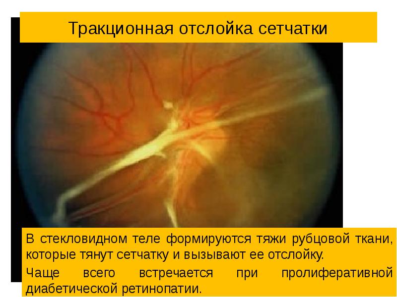 Презентация отслойка сетчатки глаза