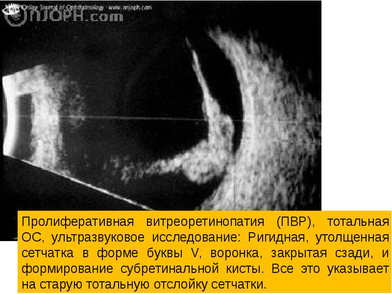 Отслойка сетчатки презентация