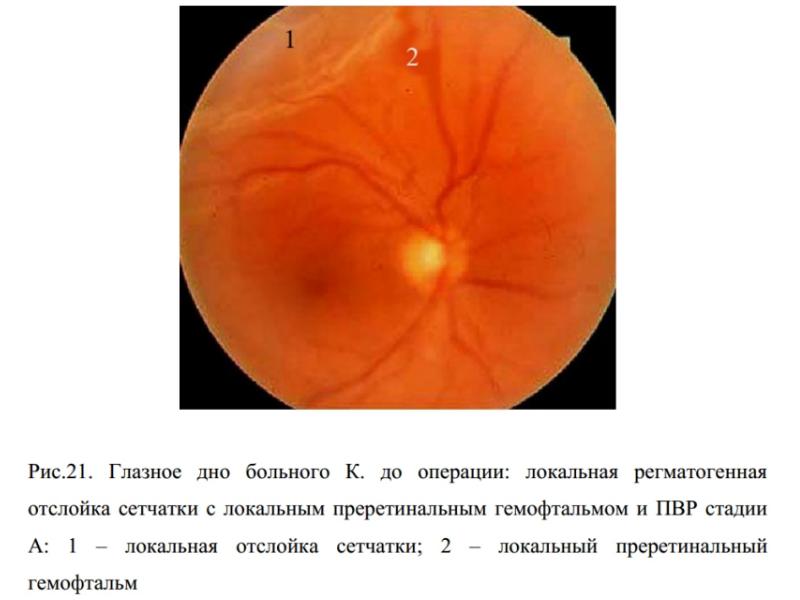 Презентация отслоение сетчатки