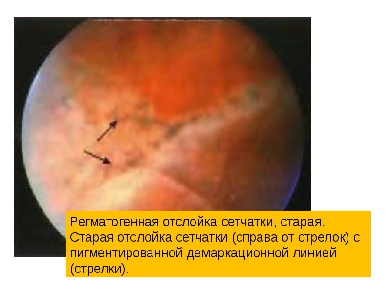 Какое изображение получается на сетчатке