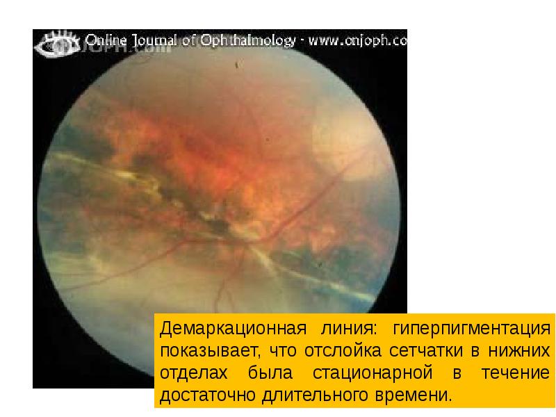 Отслойка сетчатки презентация