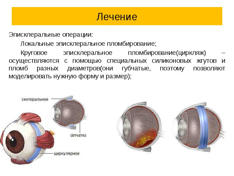 Отслойка сетчатки презентация