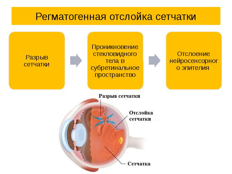 Как создается четкое изображение на сетчатке когда