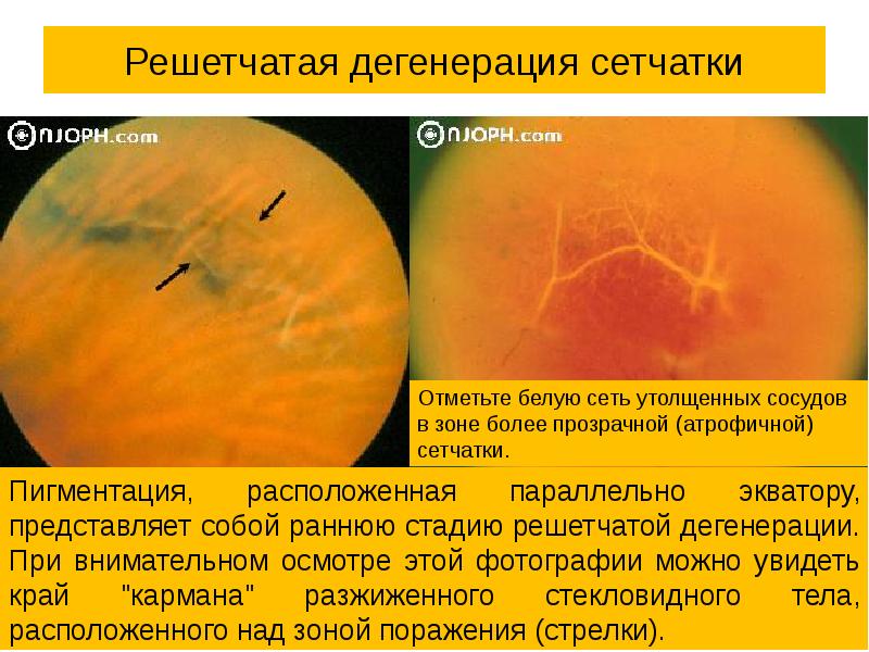 Как создается четкое изображение на сетчатке когда