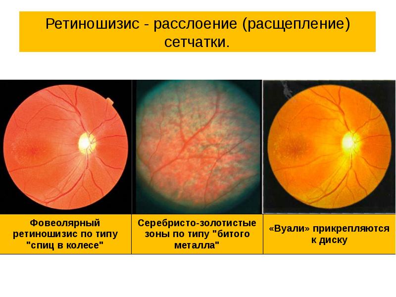 Презентация отслойка сетчатки глаза