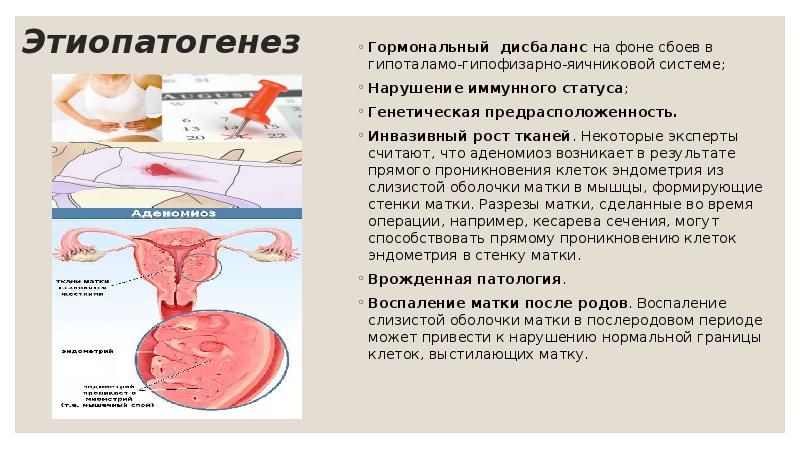 Как выглядит аденомиоз матки фото