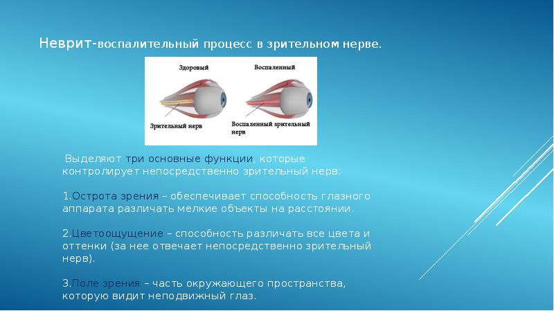 Неврит зрительного нерва презентация