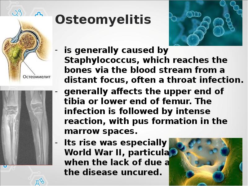 Osteomyelitis