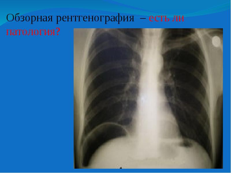 Суть рентгена. Суть рентгенографии. Контрастность рентгеновского снимка бывает. 4. Обзорная рентгенография. Рентгенография какая бывает.