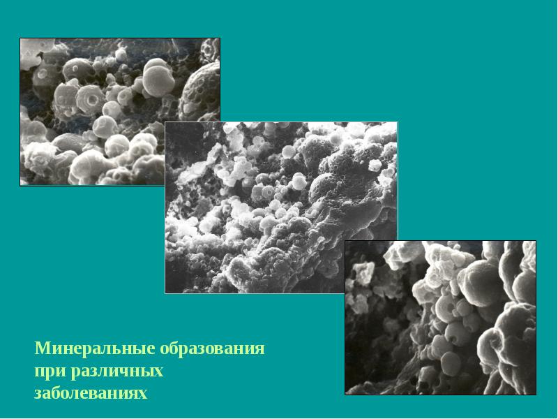 Минеральное образование. Минеральные образования. Заболевание образование минералов в толще кожи.