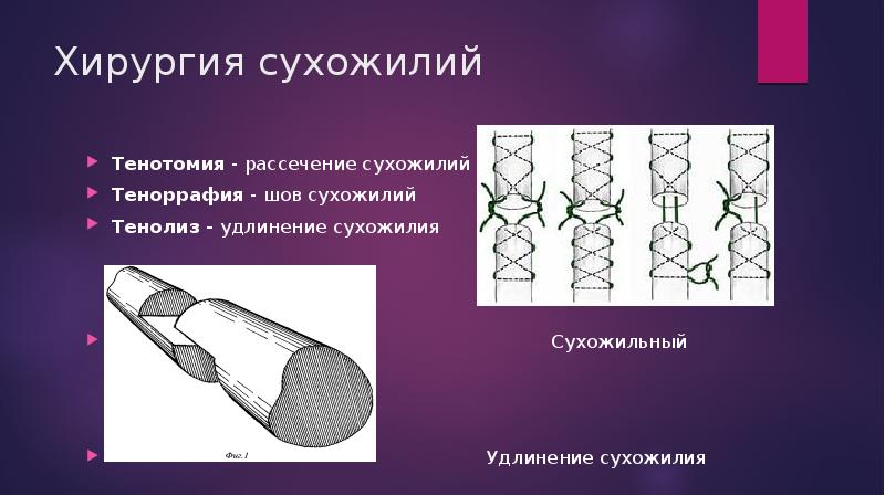 Презентация операции на сухожилиях