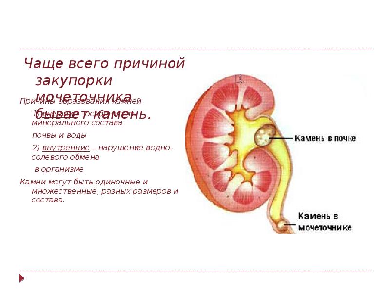 Почечная колика презентации