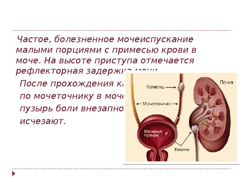 Почечная колика презентация