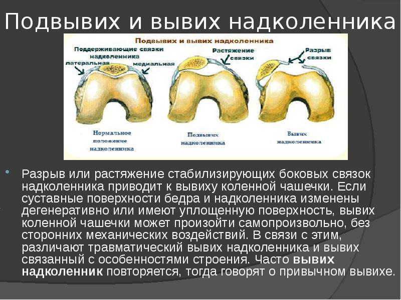 Перелом надколенника карта вызова смп